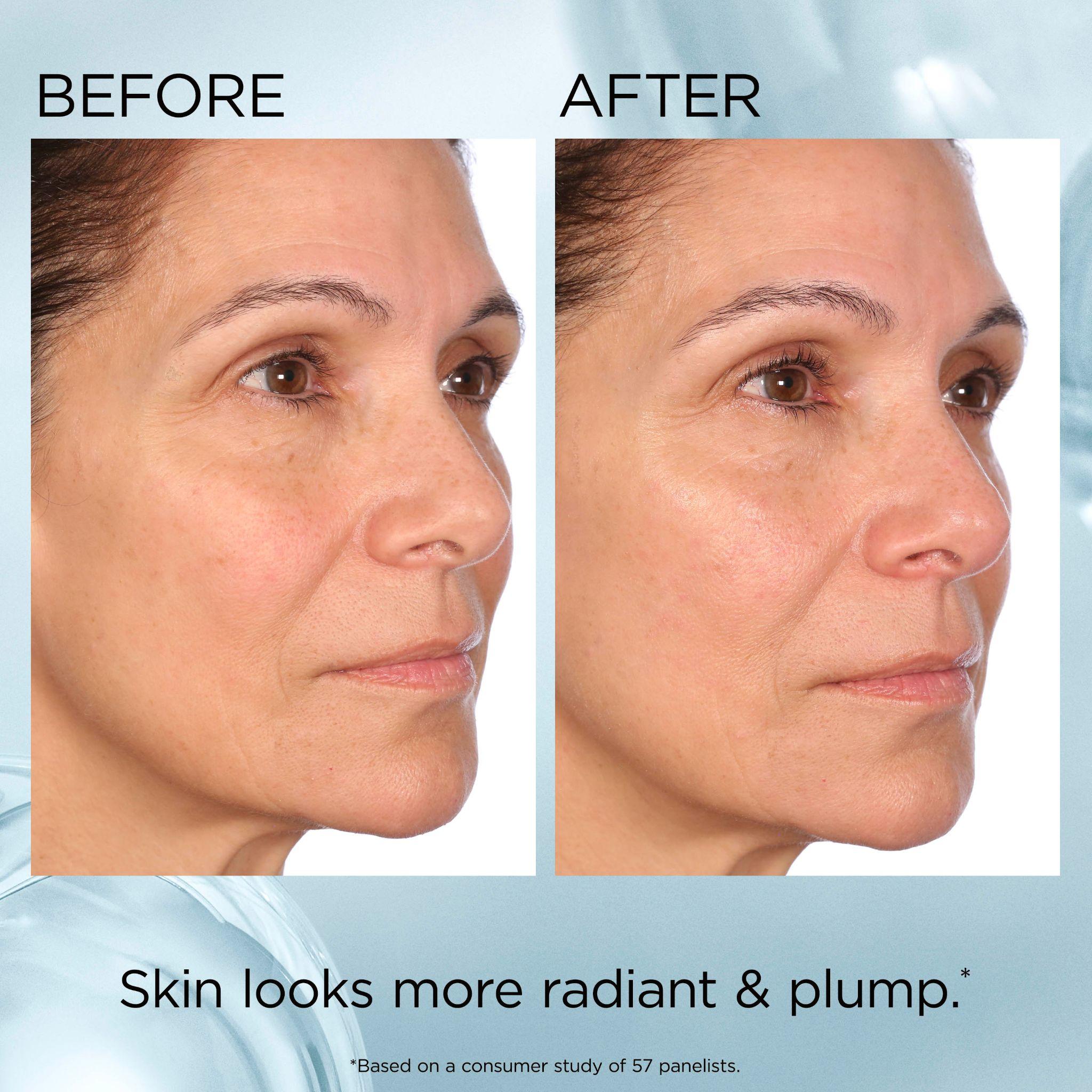 Before and after — visibly plumper, smoother skin